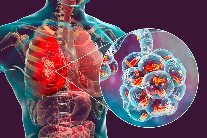 foto ai raggi x di polmoni affetti da polmonite da legionella